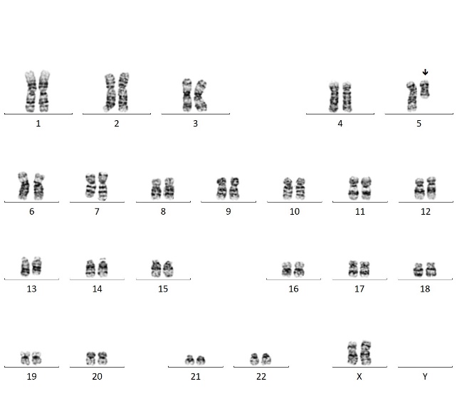 Deletion 5q female k-type