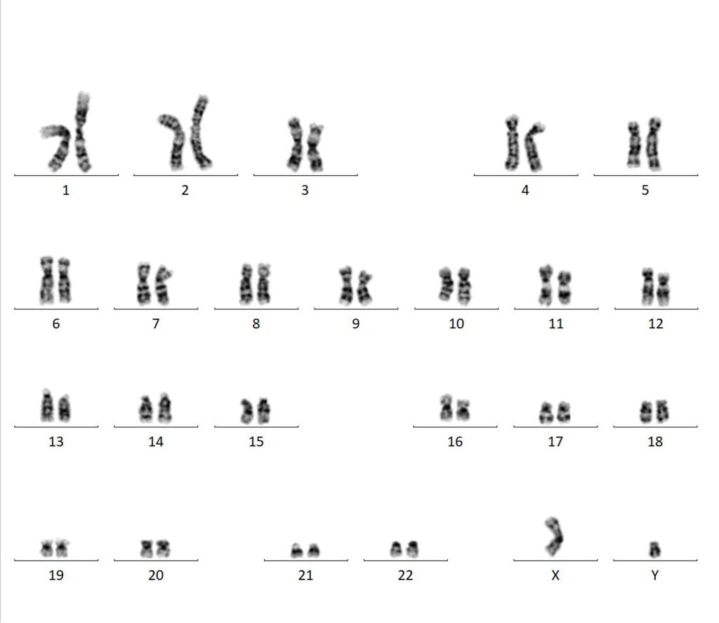 Normal male karyotype